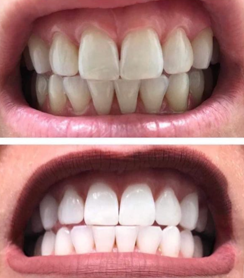 Bandes de blanchiments dentaires - la formule saine pour vos dents